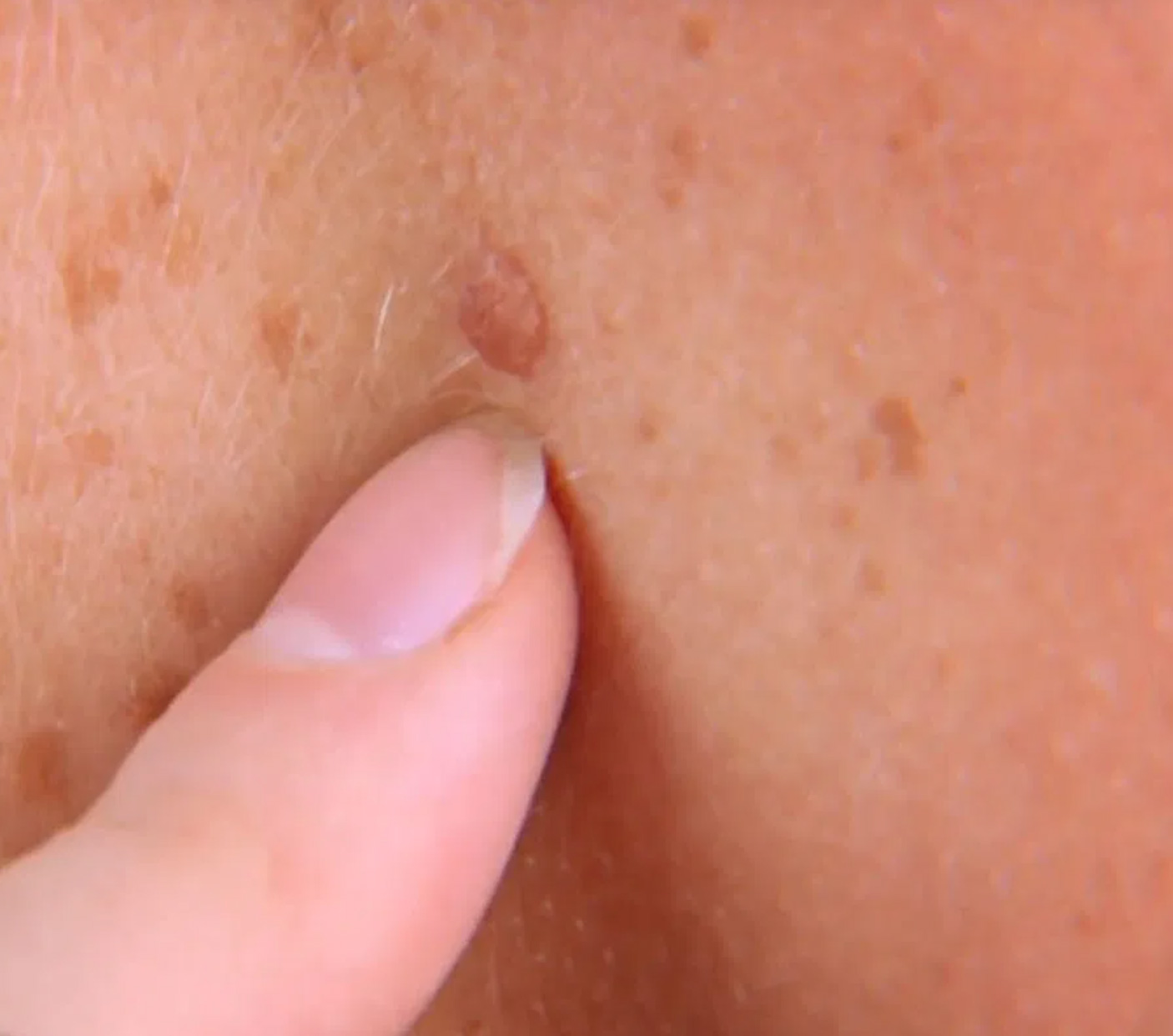 skin cancer moles on arms