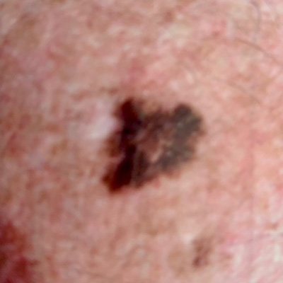 Skin Cancer Types - MoleChex - Skin Cancer and Melanoma Clinic