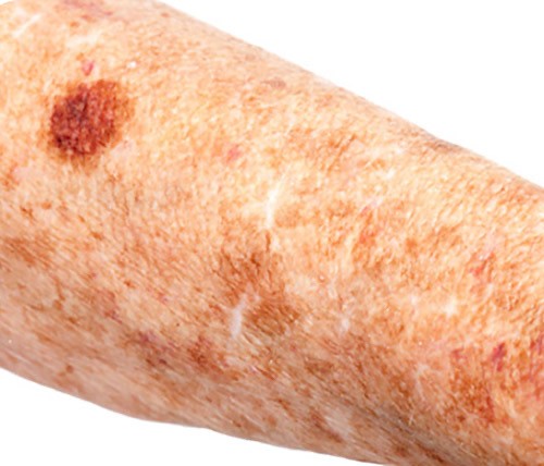 Skin Diseases Molechex Skin Cancer And Melanoma Clinic