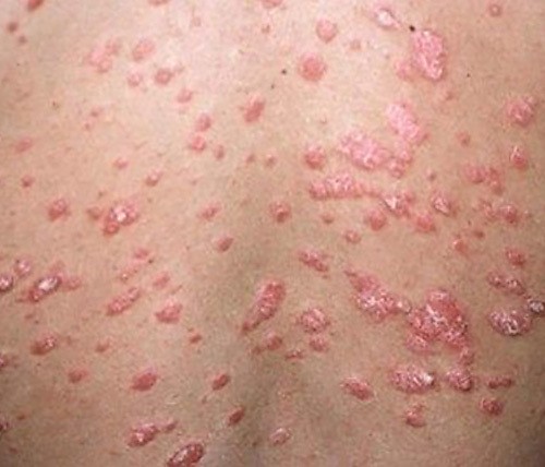 Psoriasis Specialist Raleigh Nc