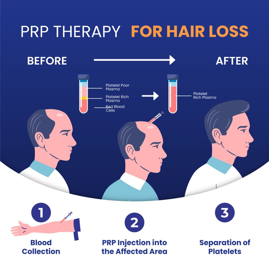 PRP-Hairloss