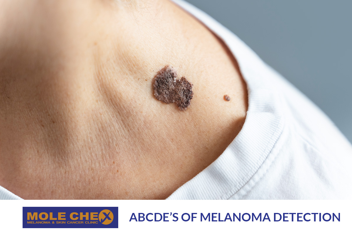 Know the ABCDEs of Melanoma Detection