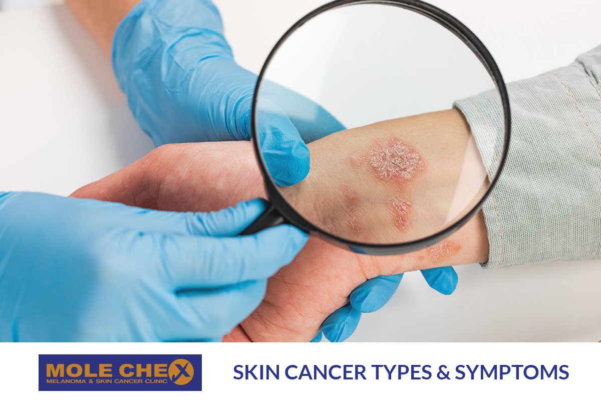 Spotlight on Skin Cancer Types & Symptoms: A First Step to Skin Cancer Treatment