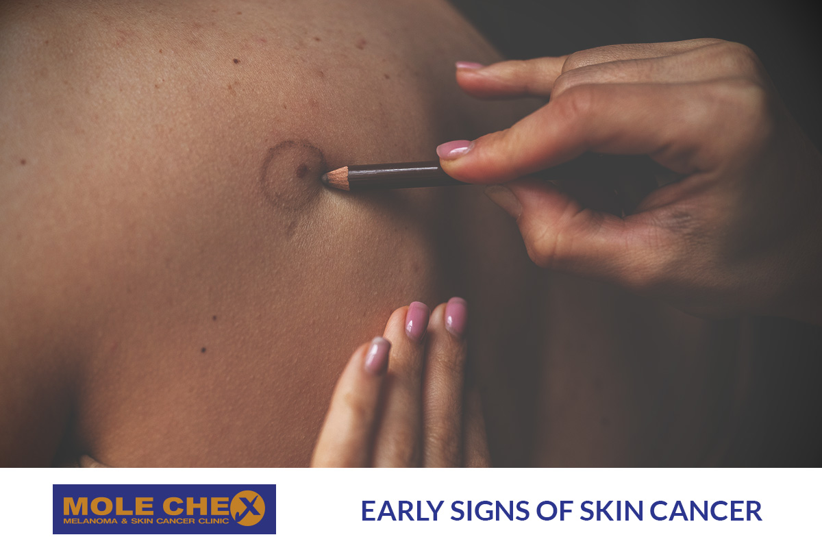 Early Signs of Skin Cancer: What to Look Out For