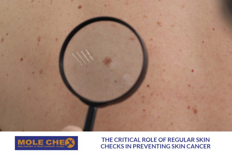 The Critical Role of Regular Skin Checks in Preventing Skin Cancer
