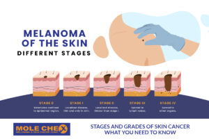 Stages and Grades of Skin Cancer: What You Need to Know