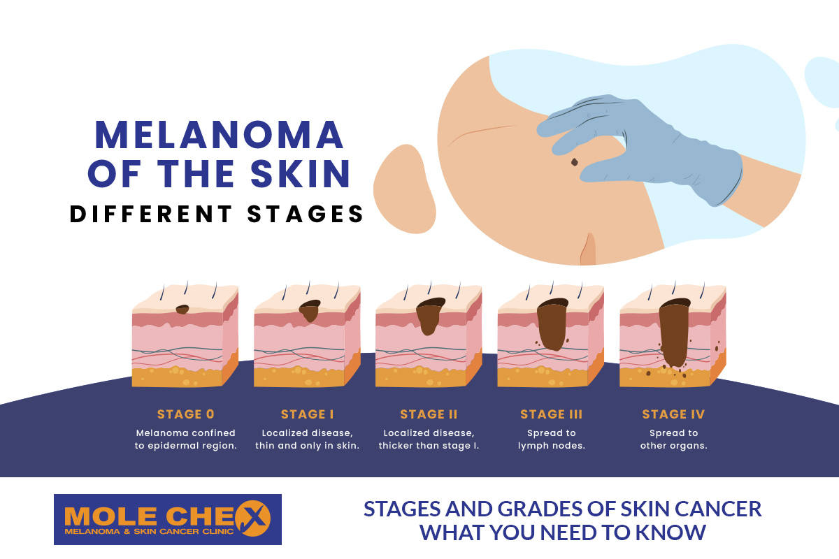 Melanoma Stages Nodular Melanoma Blood Blister Symptoms Causes