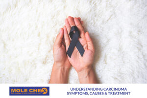 Understanding Carcinoma: Symptoms, Causes and Treatment