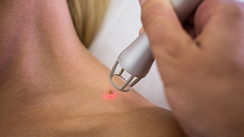 Laser Surgical Treatments