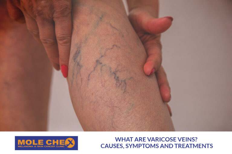 What Are Varicose Veins? Causes, Symptoms and Treatments