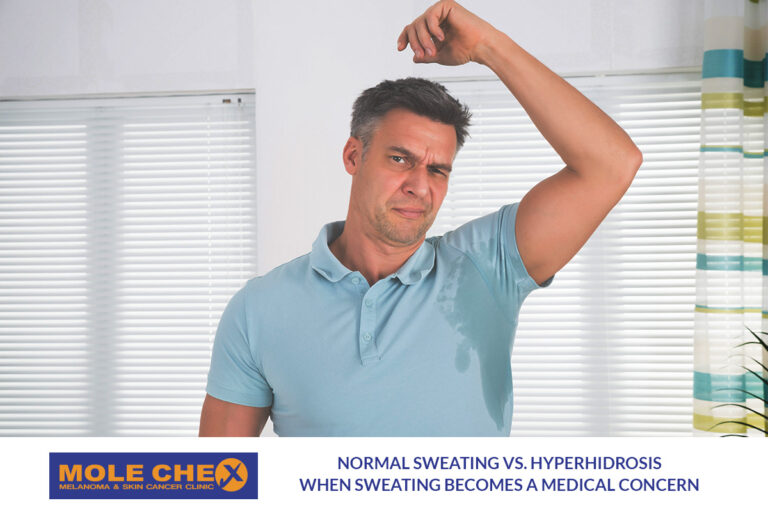 Sweating vs. Hyperhidrosis