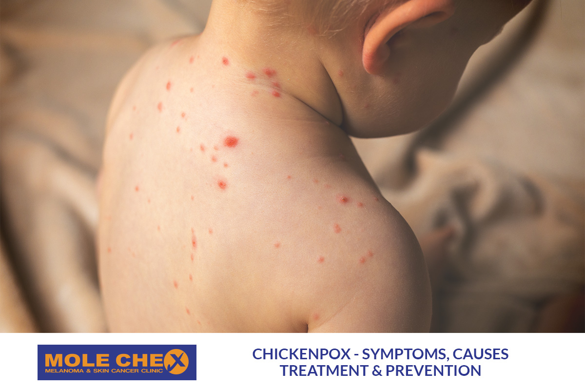 What Is Chickenpox