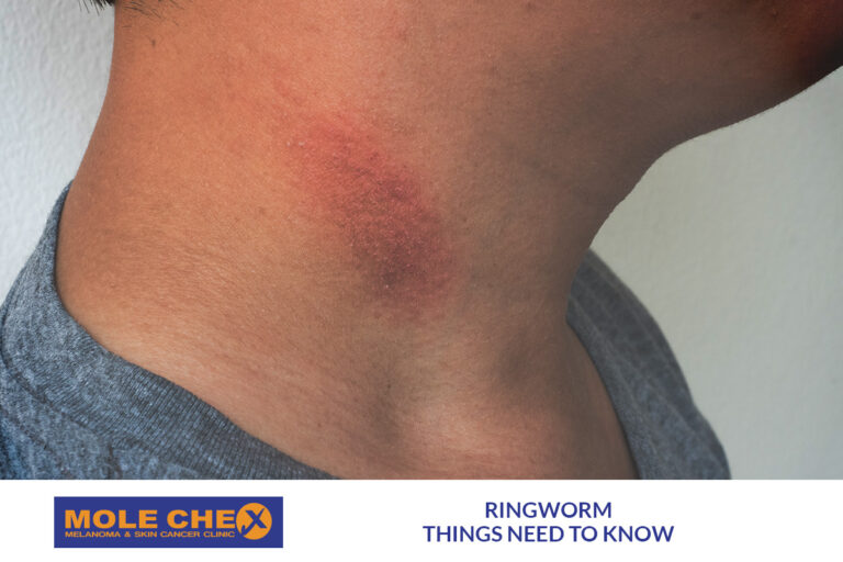 Ringworm: What to Know and Do