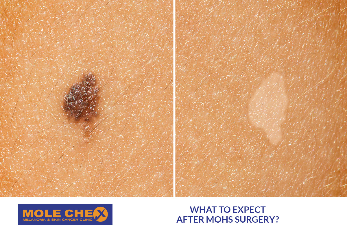 What to Expect After Mohs Surgery - Recovery Guide for Brisbane Residents