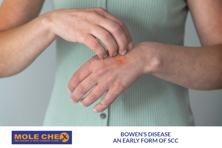 Bowen’s Disease: An Early Form of SCC Brisbane Residents Should Not Ignore