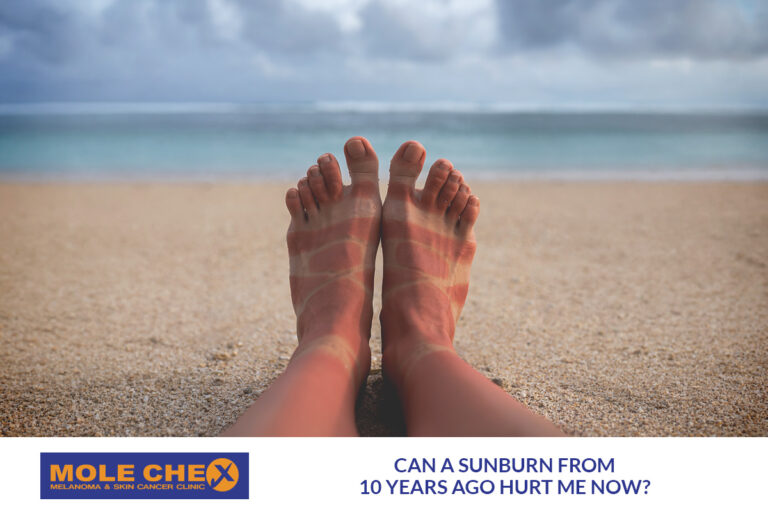 Can a Sunburn from 10 Years Ago Hurt Me Now?