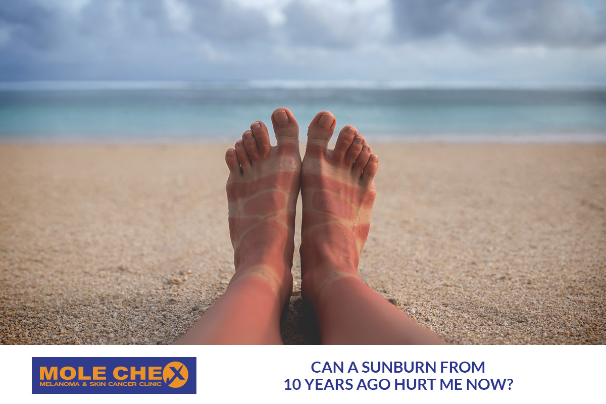 Can a Sunburn from 10 Years Ago Hurt Me Now?