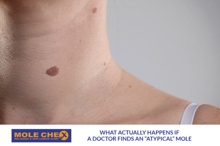 What Actually Happens If a Doctor Finds an “Atypical” Mole?