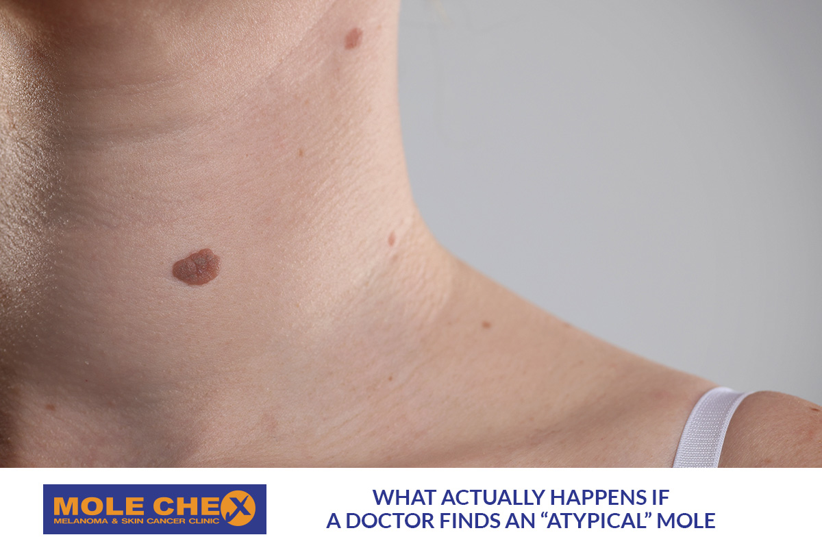 What Actually Happens If a Doctor Finds an “Atypical” Mole?